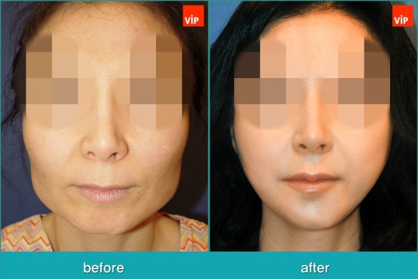 	Facial Bone Surgery, Stem Cell Fat Graft	 - Face Contouring Surgery, V-line Jaw Reduction, Fat Graft, Cheekbone Reduction