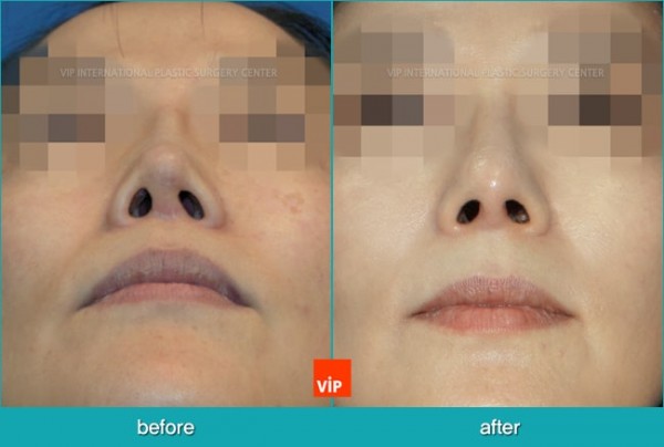 	Nose Surgery, Rib cartilage Rhinoplasty, Contracted Nose, Revision Rhinoplasty	 - Rib Cartilage Rhinoplasty