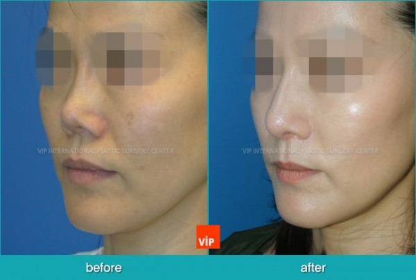 	Nose Surgery, Rib cartilage Rhinoplasty, Contracted Nose, Revision Rhinoplasty	 - Rib Cartilage Rhinoplasty