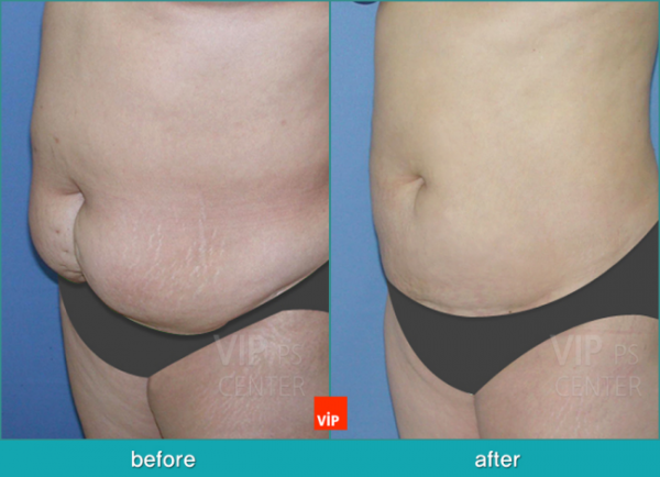 	Body Contouring	 - Liposuction