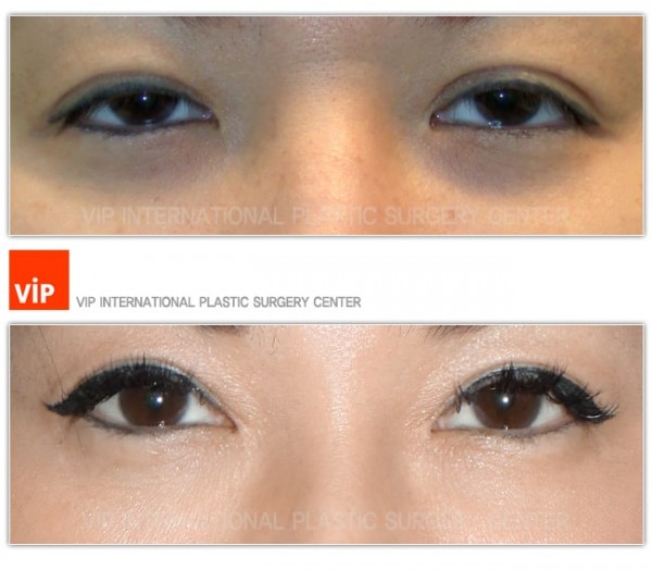 	Double Fold, Ptosis Correction, Epicanthoplasty	 - Double Fold, Ptosis Correction, Epicanthoplasty