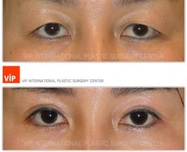 Ptosis Correction