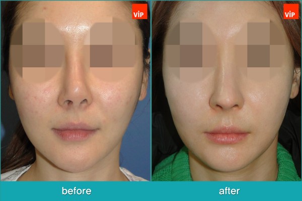 Nose Surgery - Rib cartilage Rhinoplasty