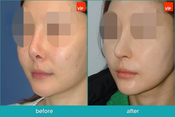 Nose Surgery - Rib cartilage Rhinoplasty