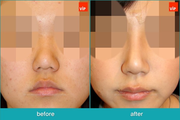 	Nose Surgery, Each Cases Nose	 - Nose Surgery