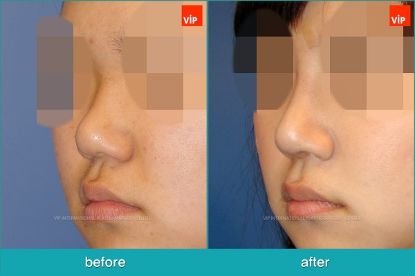 	Nose Surgery, Each Cases Nose	 - Nose Surgery