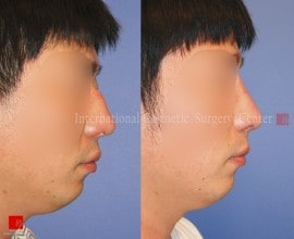 2nd Op. - Rib cartilage rhinoplasty