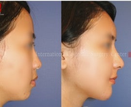 Autologous Rhinoplasty and Fat graft