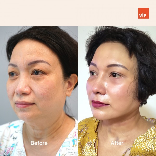 Nose Surgery, Face Lift - Deep Plane Facelift, Neck lift, Rib Cartilage Rhinoplasty