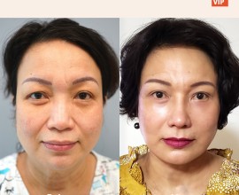 Deep Plane Facelift, Neck lift, Rib Cartilage Rhinoplasty