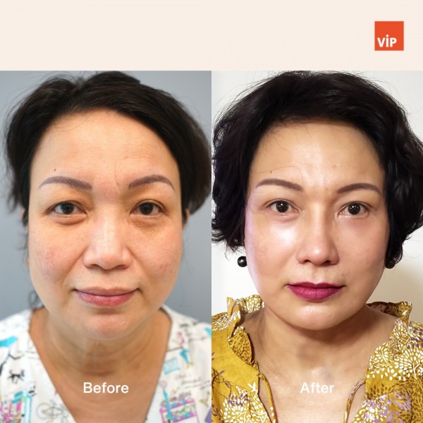 Nose Surgery, Face Lift - Deep Plane Facelift, Neck lift, Rib Cartilage Rhinoplasty