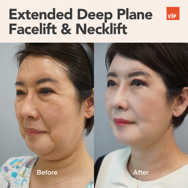 Face Lift - Extended Deep Plane Facelift & Necklift