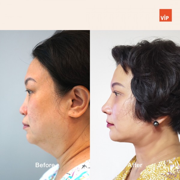 Nose Surgery, Face Lift - Deep Plane Facelift, Neck lift, Rib Cartilage Rhinoplasty