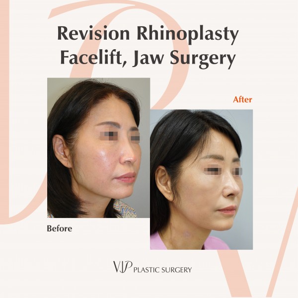 Nose Surgery, Facial Bone Surgery, Face Lift - Revision Rhinoplasty, Facelift, Jaw Surgery