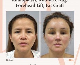 Rhinoplasty, fat graft, forehead lift