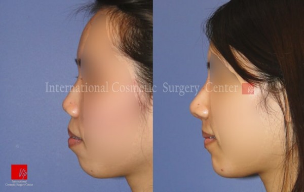 	Nose Surgery, Harmony-Rhinoplasty, Rib cartilage Rhinoplasty	 - Correction of protruded mouth with Harmony rhinoplasty