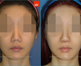 Rib cartilage Rhinoplasty