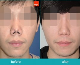 Revision rhinoplasty