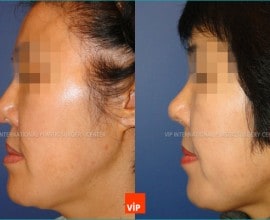 Harmony Rhinoplasty