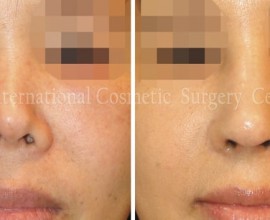 Harmony rhinoplasty - 100% Rib cartilage