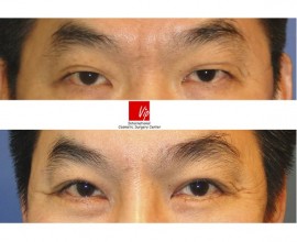 Forehead endoscope surgery & Upper blepharoplasty