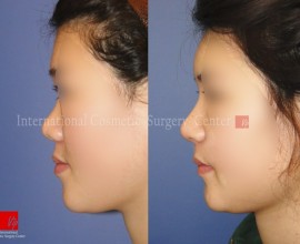 Harmony line rhinoplasty