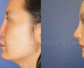 Harmony rhinoplasty  using Rib cartilage