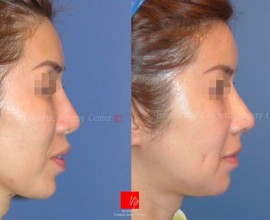 Revisional rhinoplasty using Rib carilage