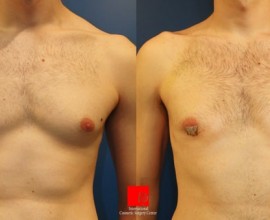 Gynecomastia