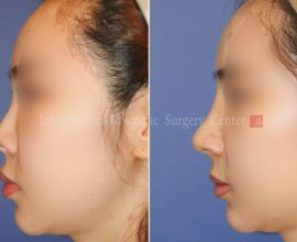 Rib cartilage rhinoplasty-silicone infection