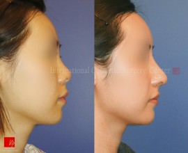 Harmony rhinoplasty