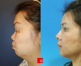 Harmony Face which includes rhinoplasty and genioplasty