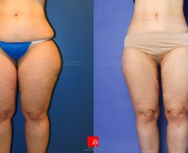 Body Liposuction