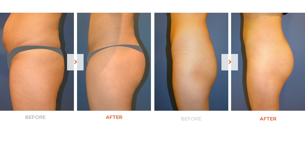 Brazilian Butt Lift Before and After