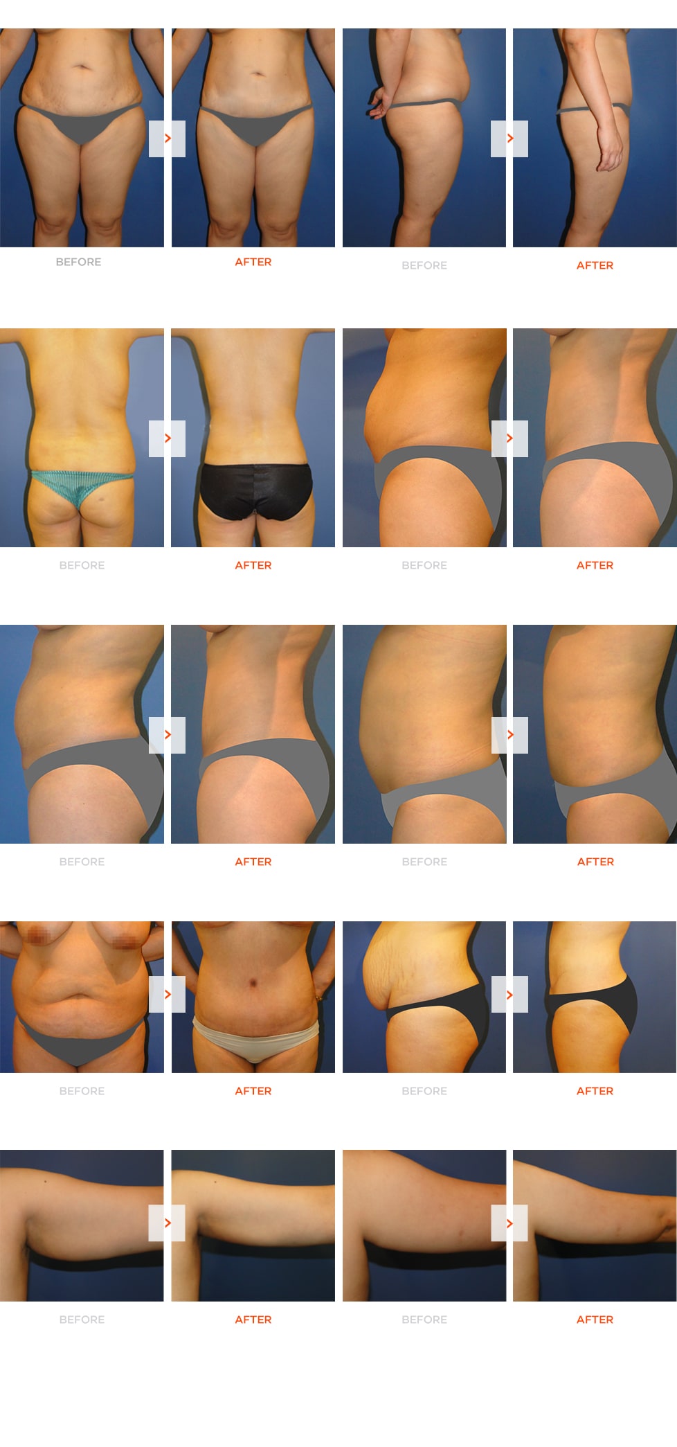 Liposuction Before and After