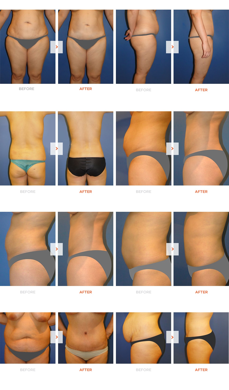 Tummy-Tuck Before and After