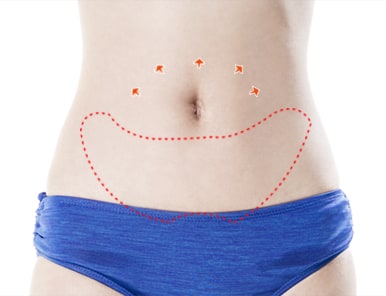 Tummy Tuck – removing excess skin and fat tissue
