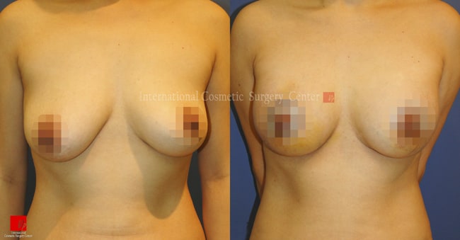 Breast lift before and after