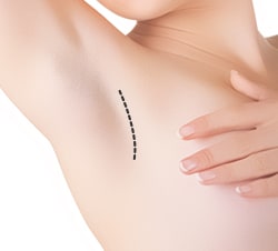 Armpit Incision Type of Breast Augmentation Surgery