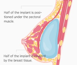 Dual Plane Insertion Type of Breast Augmentation Incision