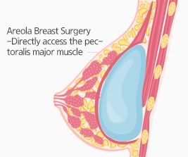 Areola Breast Surgery(W-areola Incision method)