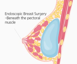 VIP Endoscopic Breast Surgery