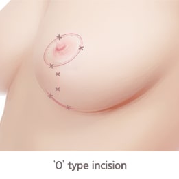 O Type Incision(Breast Lift Incision Type)