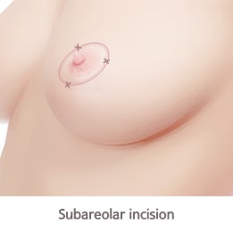 Subareolar Incision(Breast Lift Incision Type)