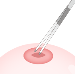 ขั้นตอนs for Purse-String Suture Method