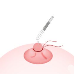 ขั้นตอนs for Purse-String Suture Method