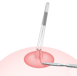 ขั้นตอนs for Lactiferous Duct Incision-cannot breastfeed