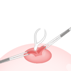 ขั้นตอนs for Lactiferous Duct Incision-cannot breastfeed