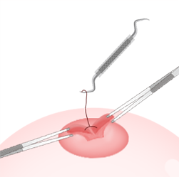 ขั้นตอนs for Lactiferous Duct Incision-cannot breastfeed