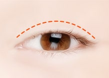 Steps for Incision Double Eyelid Surgery Method